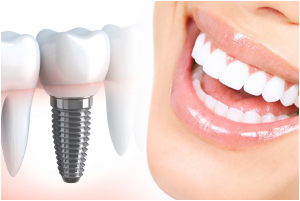 На какой челюсти хотите поставить импланты?