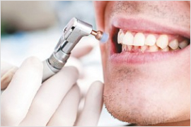 Комплексная чистка зубов Airflow